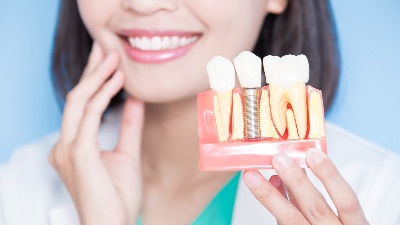 インプラント治療前に知っておきたいこと【歯科医が解説】幻冬社GOLD ONLINE