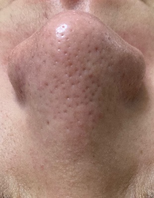 韓国式3D毛穴洗浄®